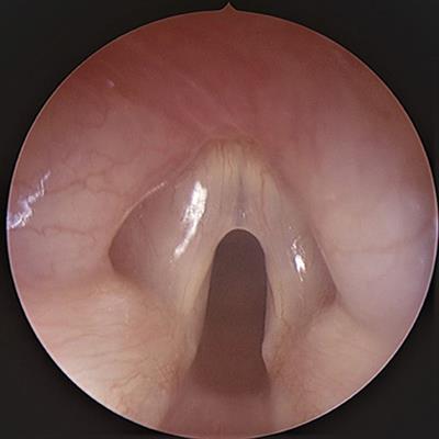 Case Report: Ultrasound Guided Mucosal Fold Lateralization for Laryngeal Webs
